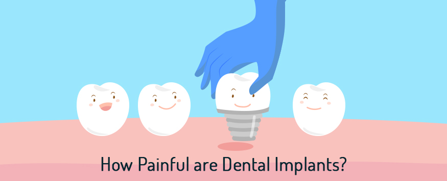 dental-implants.jpg